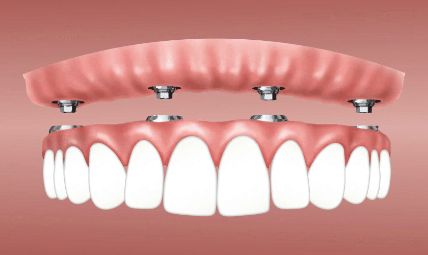 Dental Implants in Tempe,AZ