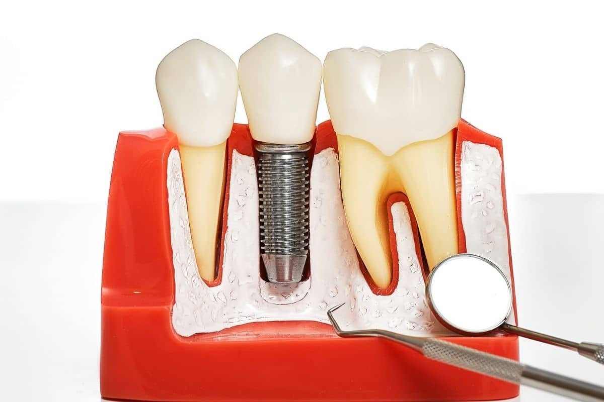 Dental implant model showing natural teeth, implant screw, and crown restoration in Tempe.