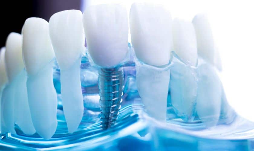 Dental Implants in Tempe - Do Good Dental