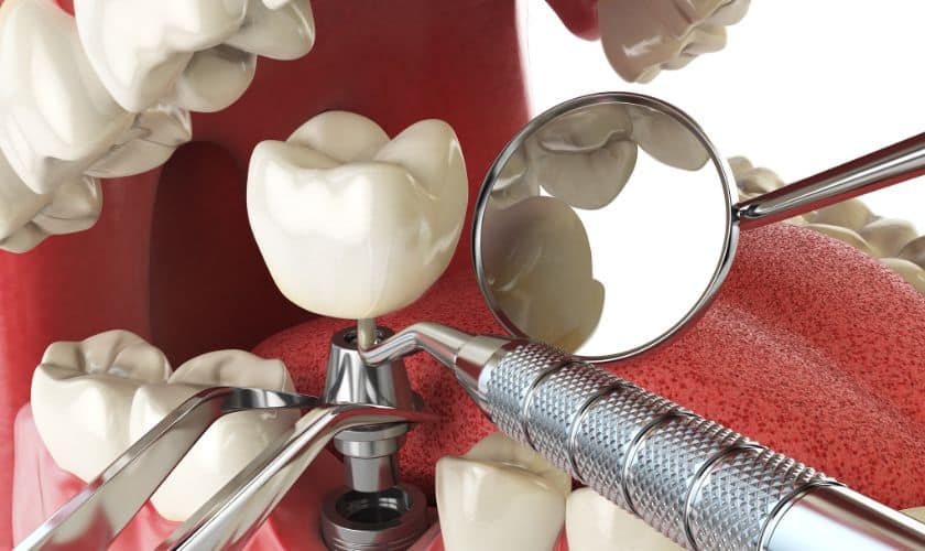 Dental Implants Tempe - Do Good Dental
