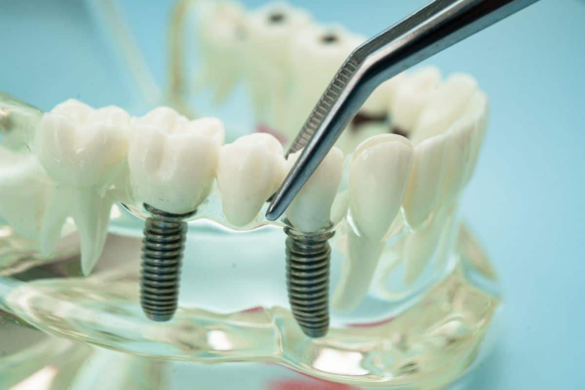 Dental Implant Care