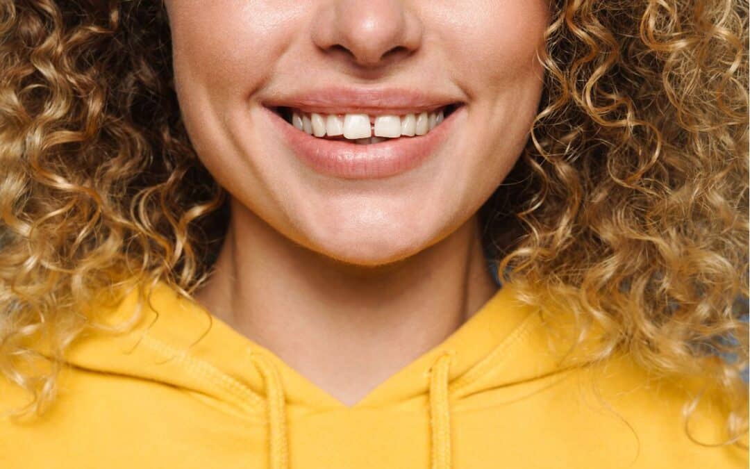 Gappy or Crooked Teeth? How Cosmetic Treatments Can Benefit