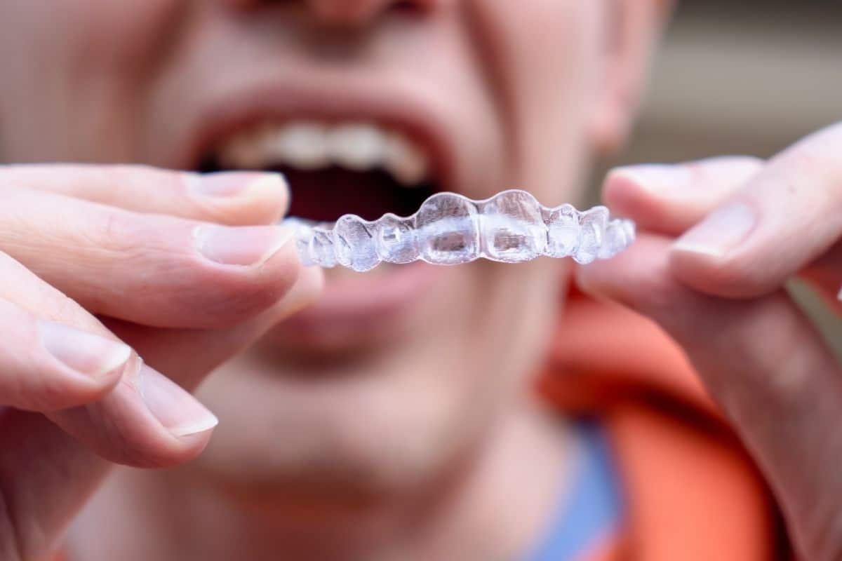 Clear Aligners