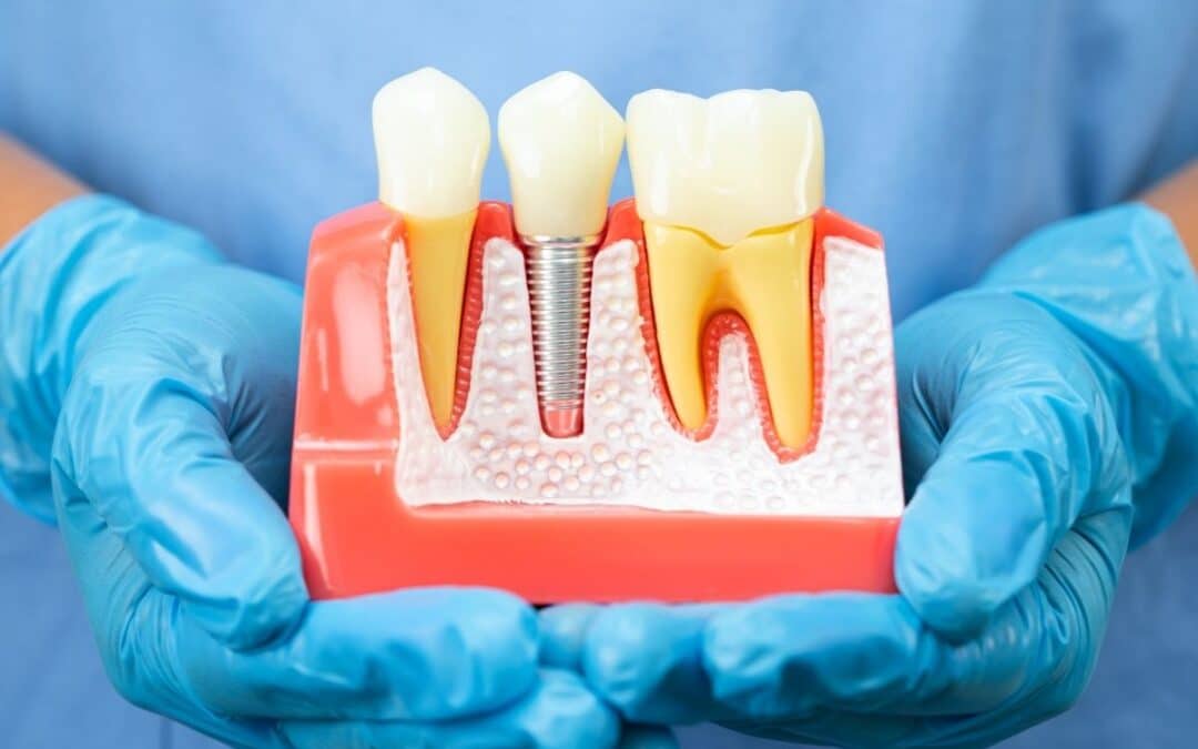 How Long Do Dental Implants Last?