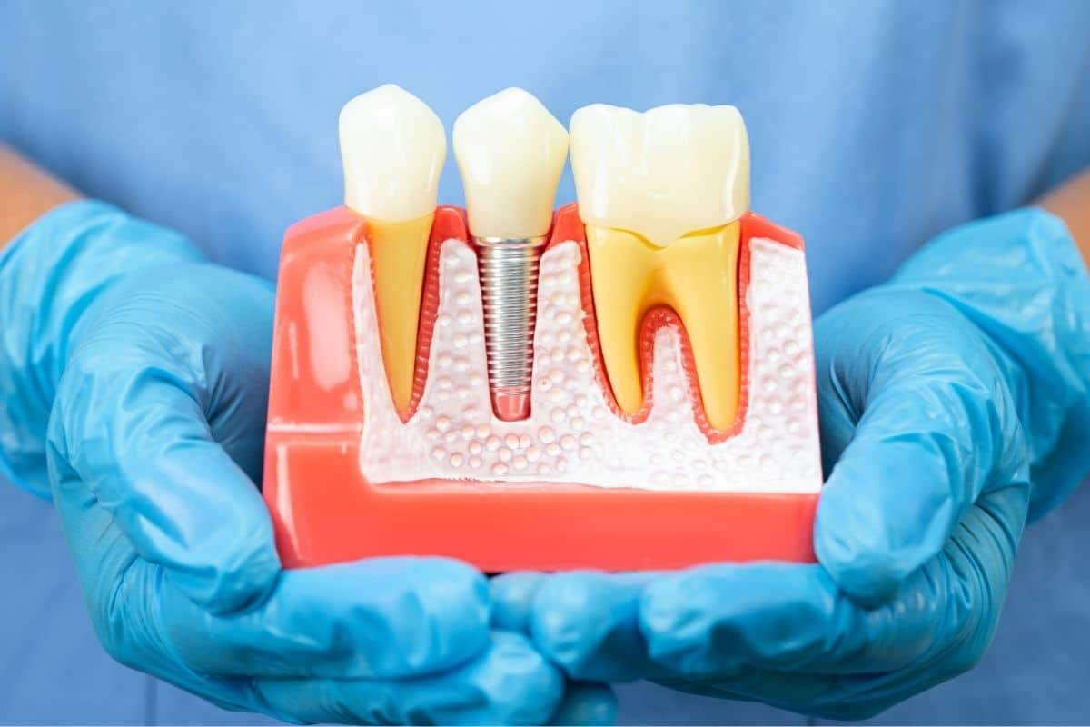Dental implant model showing natural tooth, implant with screw, and tooth structure comparison.