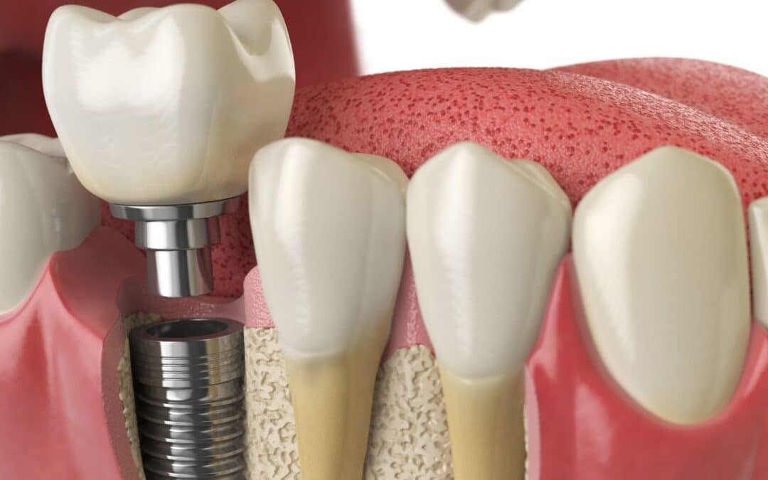 Dental Implants Before and After: What to Expect