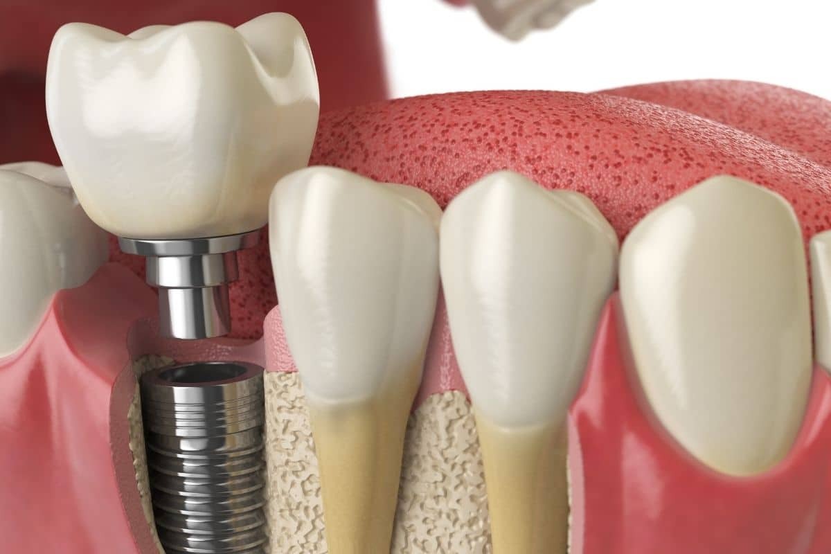 Dental implant diagram showing titanium screw anchor, bone structure, and natural-looking crown restoration.