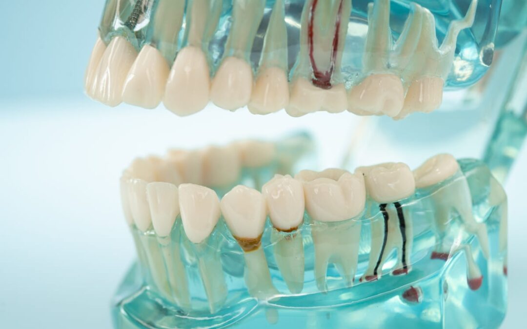What to Eat After Your Root Canal: A Complete Recovery Guide