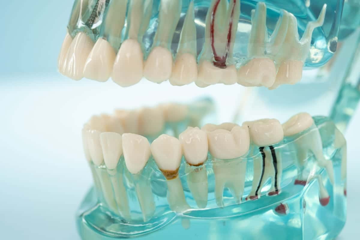 Dental implant models showing natural-looking tooth crowns on transparent anatomical jaw model.