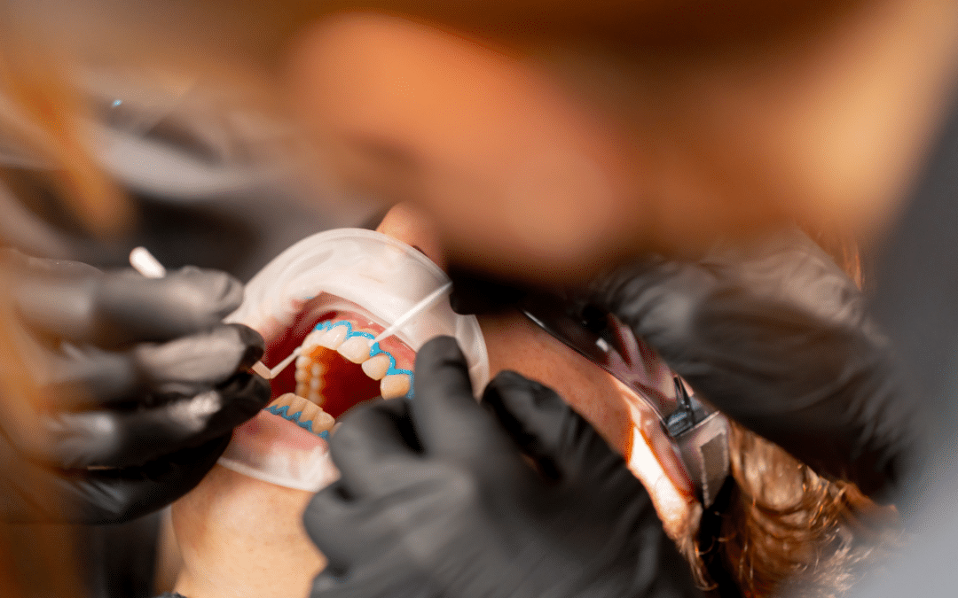 Professional vs. At-Home Teeth Whitening: Which Is Better?