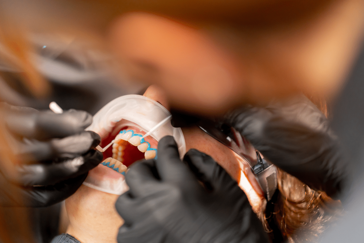 Professional vs. At-Home Teeth Whitening
